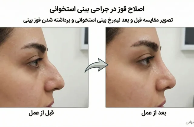 جراحی بینی استخوانی