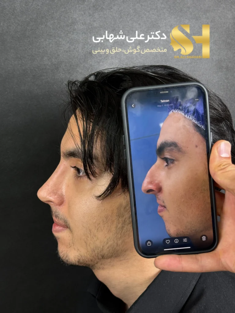 رفع قوز و اصلاح فرم بینی استخوانی در کلینیک دکتر علی شهابی
