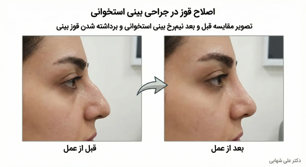 تصویر مقایسه قبل و بعد نیم‌رخ بینی استخوانی و برداشته شدن قوز بینی