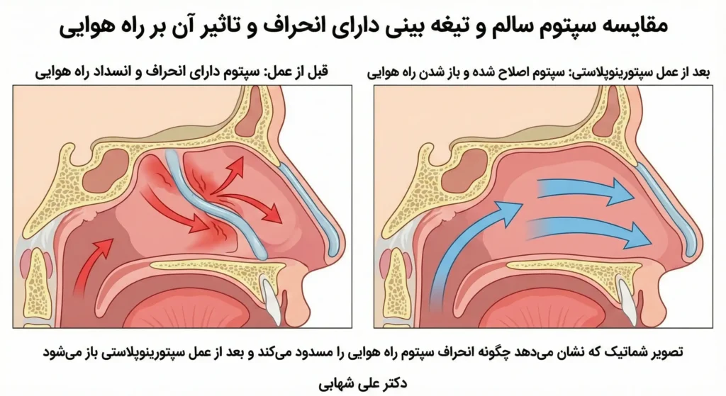 تصویر شماتیک که نشان می‌دهد چگونه انحراف سپتوم راه هوایی را مسدود می‌کند و بعد از عمل سپتورینوپلاستی باز می‌شود