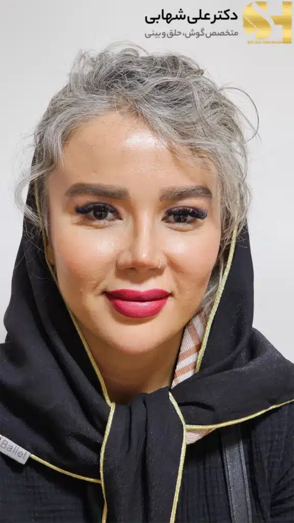 نتیجه جراحی بینی توسط دکتر علی شهابی (نمای تمام رخ)