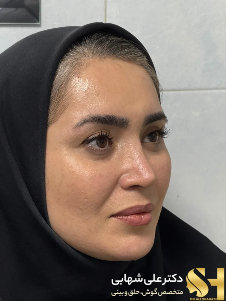 کیفیت عالی جراحی متناسب با قیمت عمل بینی دکتر علی شهابی