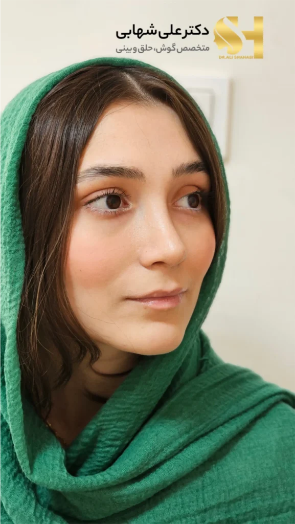چهره بعد از عمل زیبایی بینی دکتر شهابی جراح بینی در تهران