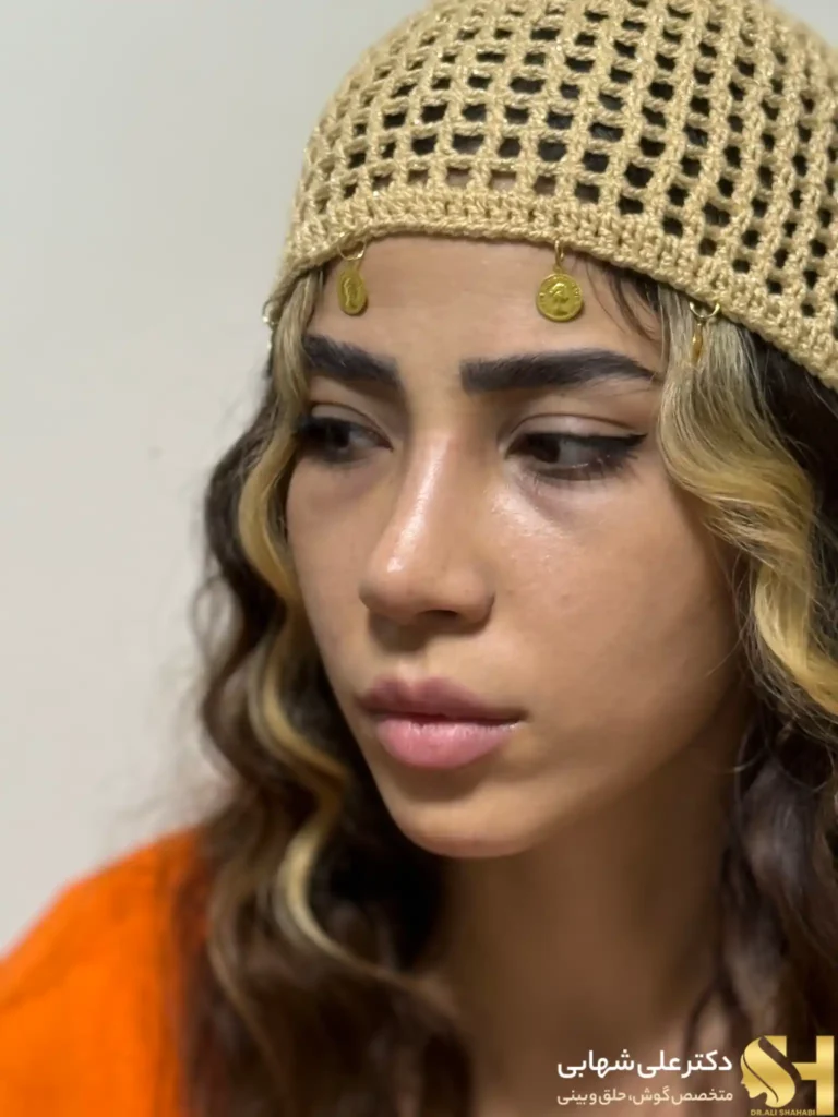 نمونه کار جراحی بینی توسط دکتر علی شهابی