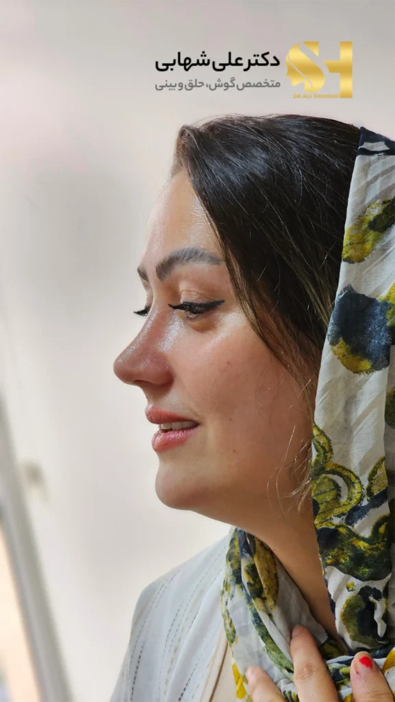 ایجاد قوس ملایم و دخترانه در نمای نیم‌رخ توسط دکتر علی شهابی