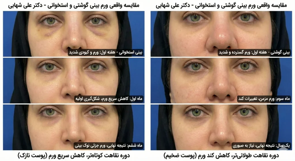 ورم بینی کی میخوابه؟ تفاوت ورم بینی گوشتی قبل و بعد از عمل