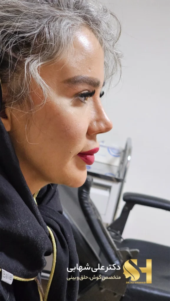 نمونه کار جراحی بینی گوشتی با پوست ضخیم توسط دکتر علی شهابی