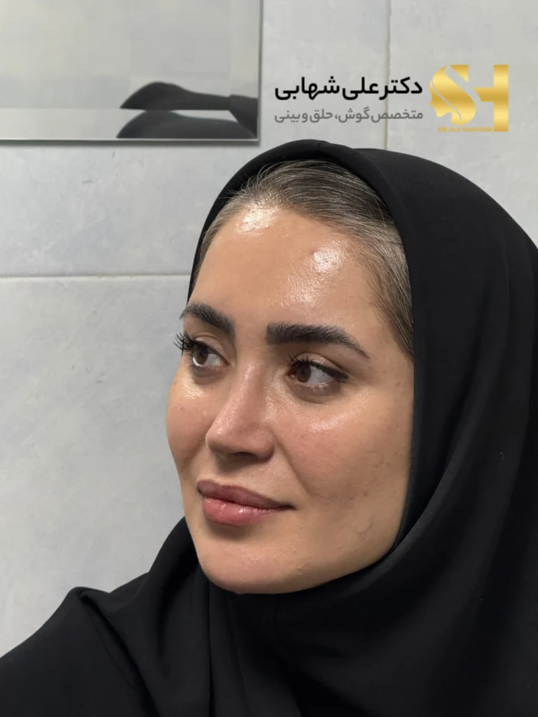 عمل بینی به سبک طبیعی و نچرال توسط علی شهابی جراح بینی