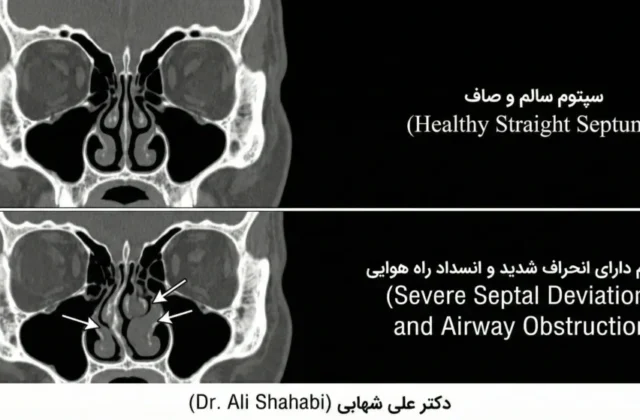 سپتوپلاستی