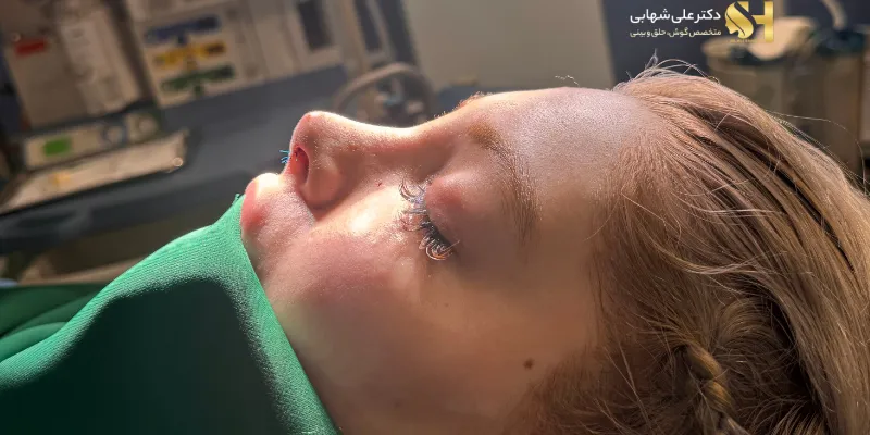 rhinoplasty-after-dr-ali-shahabi-01