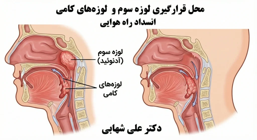 تصویر گرافیکی آناتومی حلق که نشان می‌دهد لوزه سوم پشت بینی و لوزه‌ها در گلو قرار دارند و راه هوایی را بسته‌اند