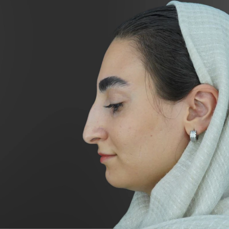 مقایسه قبل از عمل بینی زیبایی توسط دکتر علی شهابی