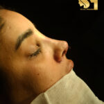 نمودار کاهش ورم بینی